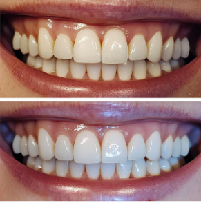 PureBright 3-Day Teeth Whitening Powder